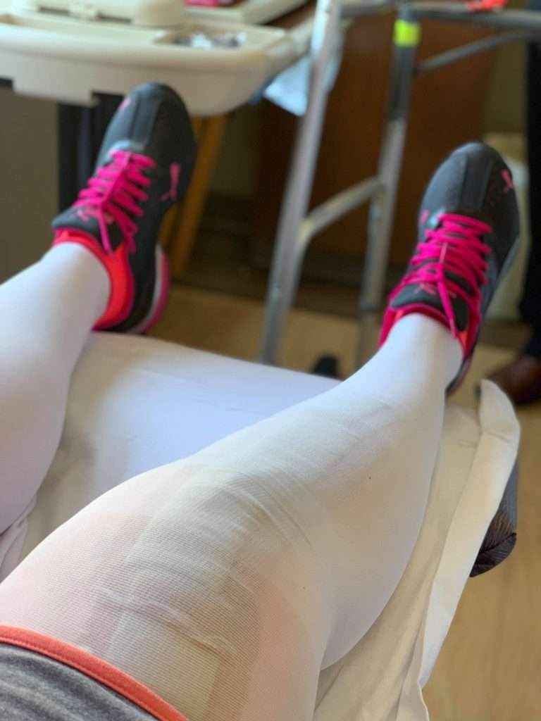 Picture of my legs post op partial knee replacement day one. Got to love the look of compression socks! Click here to learn more about the pain, insomnia, and how it feels to move your new knee. All the details of my partial knee replacement hospital stay. 