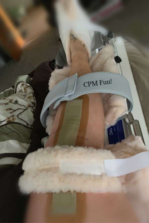 A women's leg with a bandage after partial knee replacement surgery in a CPM machine. Click here to see why this was my main view for the first four weeks after my surgery. 